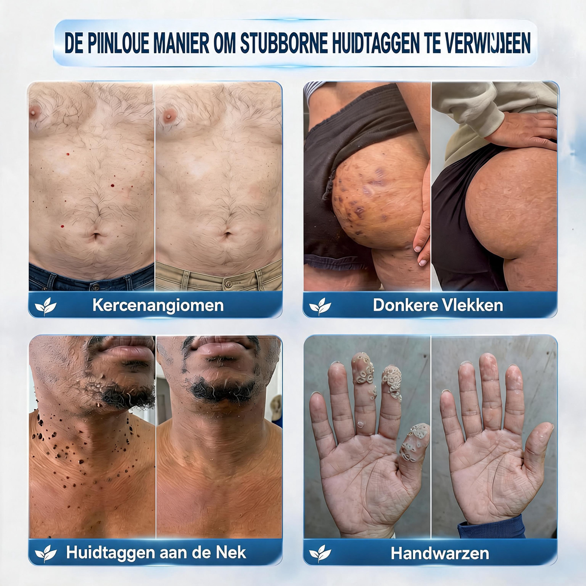 🎈Officiële merkshop | 🎉Natravor® 7-daagse wratten- en vlekkenverwijderaar (pijnstillende applicator voor nauwkeurig aanbrengen, laat geen littekens achter)