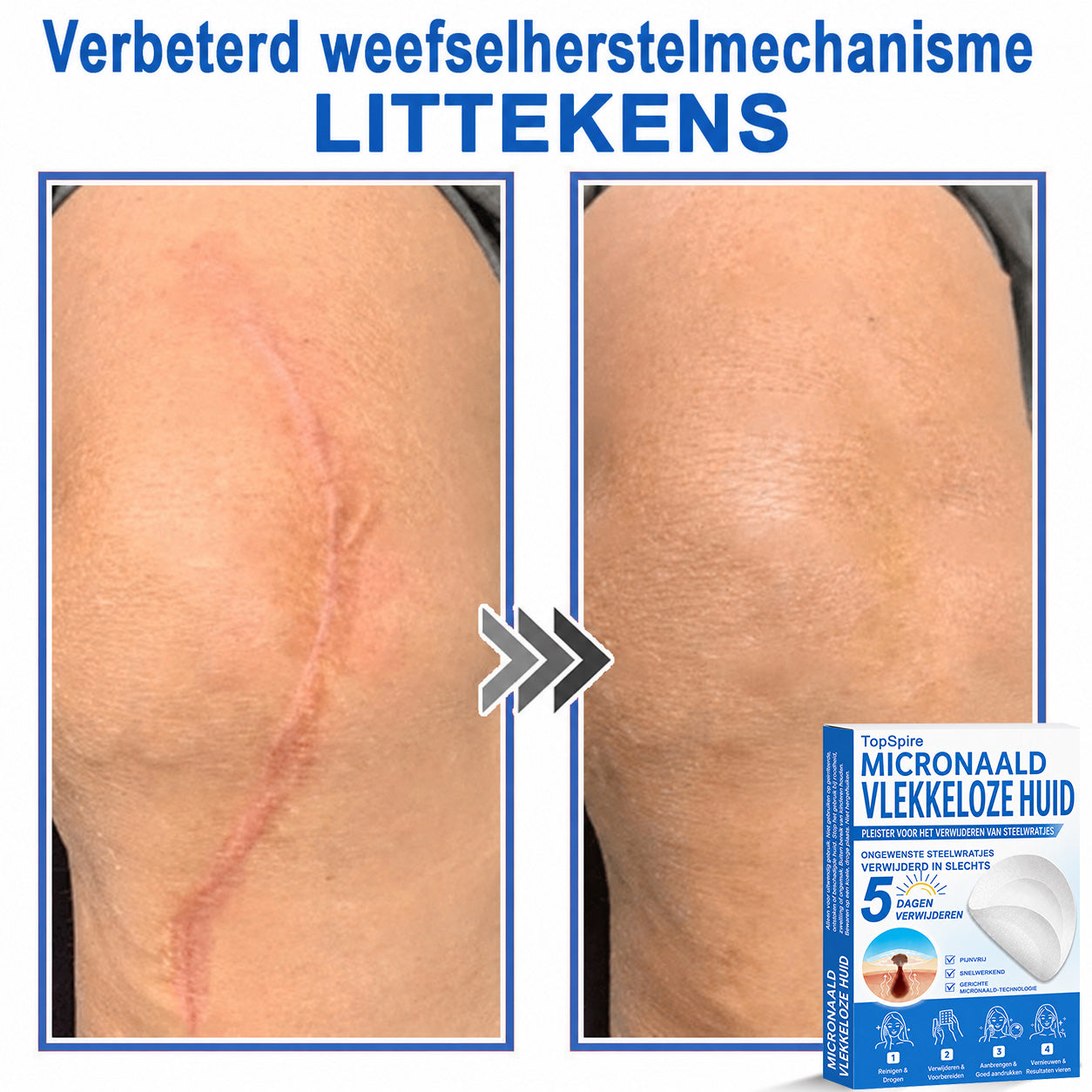 Officiële merkshop | 🎉 TopSpire® 2-in-1 Micro-naald & Hydrocolloïde Pleisters | Voor verheven moedervlekken, acne, platte wratten & huidaanhangsels