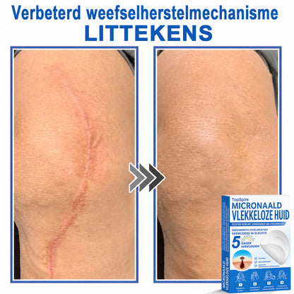Officiële merkshop | 🎉 TopSpire® 2-in-1 Micro-naald & Hydrocolloïde Pleisters | Voor verheven moedervlekken, acne, platte wratten & huidaanhangsels