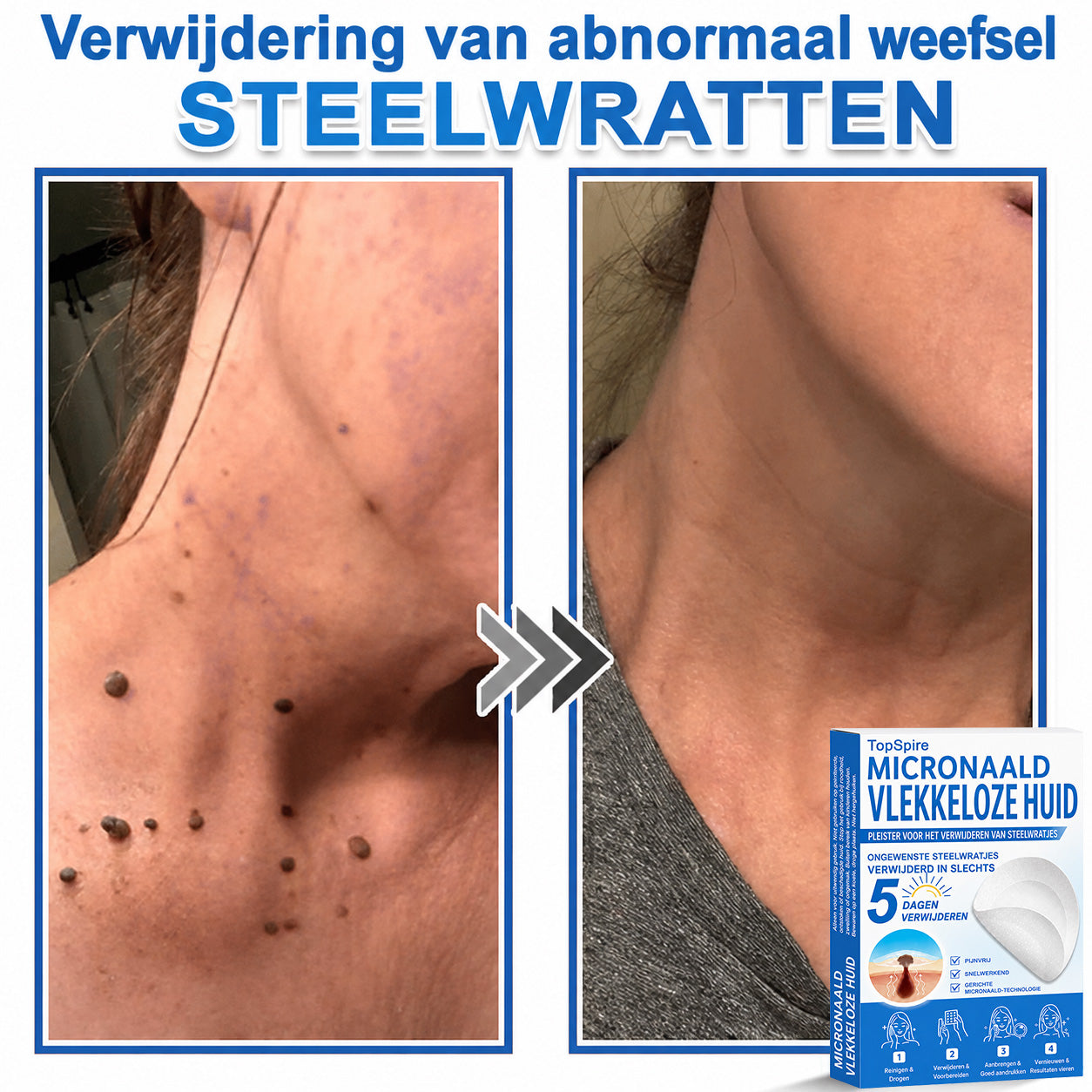 Officiële merkshop | 🎉 TopSpire® 2-in-1 Micro-naald & Hydrocolloïde Pleisters | Voor verheven moedervlekken, acne, platte wratten & huidaanhangsels