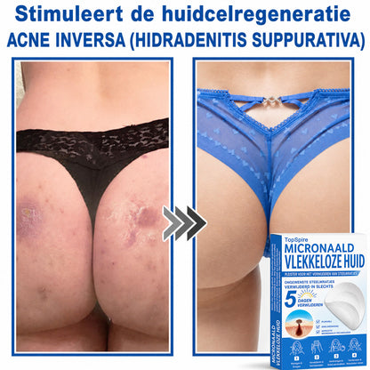 Officiële merkshop | 🎉 TopSpire® 2-in-1 Micro-naald & Hydrocolloïde Pleisters | Voor verheven moedervlekken, acne, platte wratten & huidaanhangsels