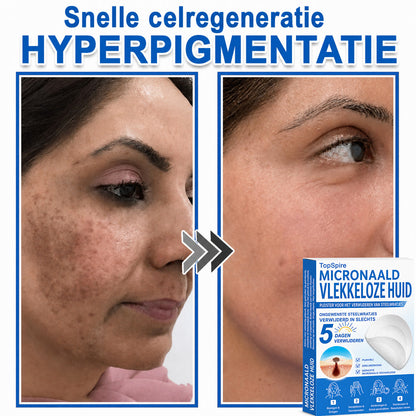 Officiële merkshop | 🎉 TopSpire® 2-in-1 Micro-naald & Hydrocolloïde Pleisters | Voor verheven moedervlekken, acne, platte wratten & huidaanhangsels