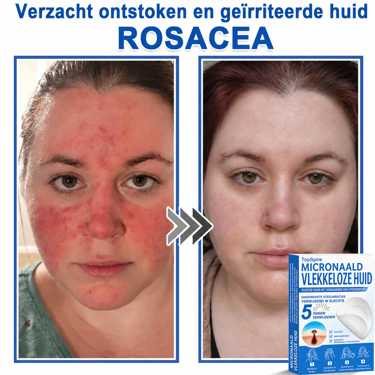Officiële merkshop | 🎉 TopSpire® 2-in-1 Micro-naald & Hydrocolloïde Pleisters | Voor verheven moedervlekken, acne, platte wratten & huidaanhangsels