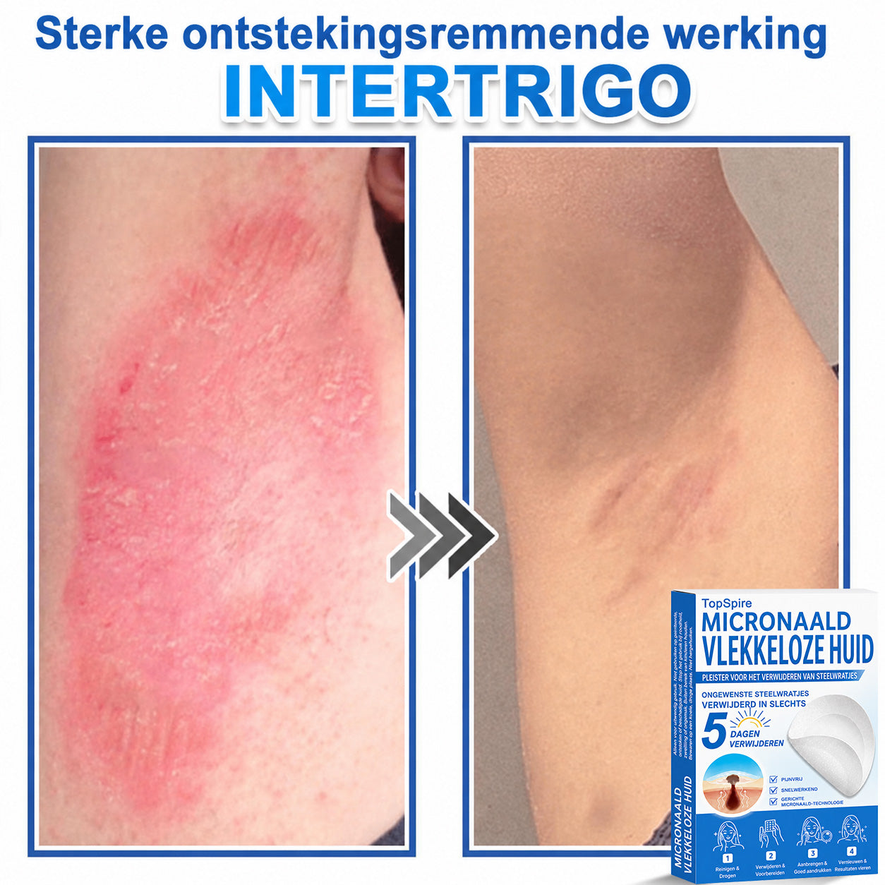 Officiële merkshop | 🎉 TopSpire® 2-in-1 Micro-naald & Hydrocolloïde Pleisters | Voor verheven moedervlekken, acne, platte wratten & huidaanhangsels