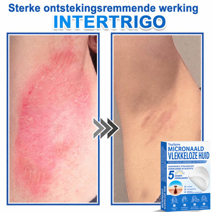 Officiële merkshop | 🎉 TopSpire® 2-in-1 Micro-naald & Hydrocolloïde Pleisters | Voor verheven moedervlekken, acne, platte wratten & huidaanhangsels