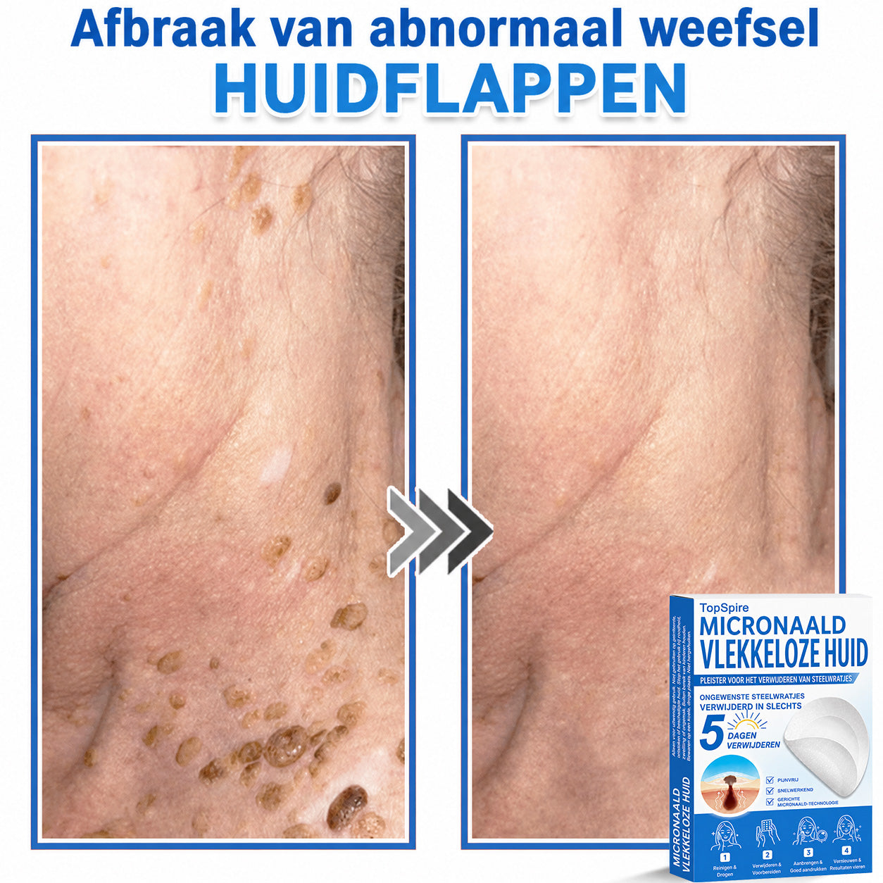 Officiële merkshop | 🎉 TopSpire® 2-in-1 Micro-naald & Hydrocolloïde Pleisters | Voor verheven moedervlekken, acne, platte wratten & huidaanhangsels