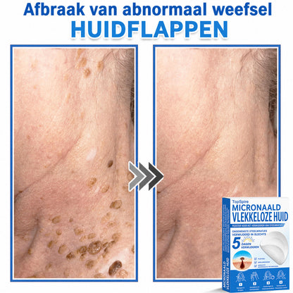Officiële merkshop | 🎉 TopSpire® 2-in-1 Micro-naald & Hydrocolloïde Pleisters | Voor verheven moedervlekken, acne, platte wratten & huidaanhangsels