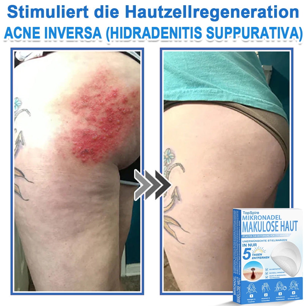 Officiële merkshop | 🎉 TopSpire® 2-in-1 Micro-naald & Hydrocolloïde Pleisters | Voor verheven moedervlekken, acne, platte wratten & huidaanhangsels