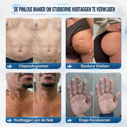 🍇Officiële merkshop | 🖊️Natravor® 7-daagse wratten- en vlekkenverwijderaar (pijnstillende applicator voor nauwkeurig aanbrengen, laat geen littekens achter)🌳